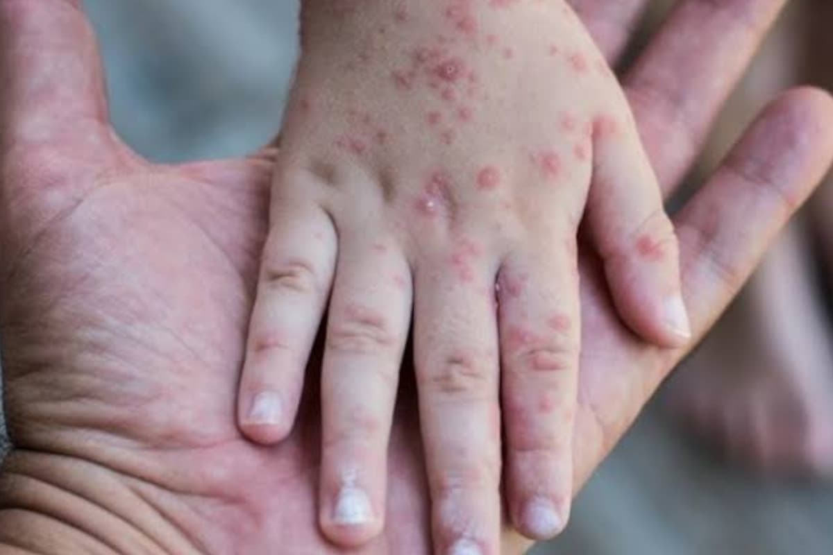 17 Suspek Campak Terdeteksi dalam Dua Bulan Terakhir, Dinkes Kota Probolinggo Minta Warga Tak Abaikan Gejala